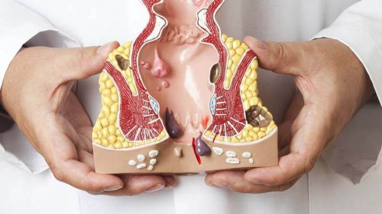 Jual Obat Wasir Ambeien De Nature Di Jakarta Selatan